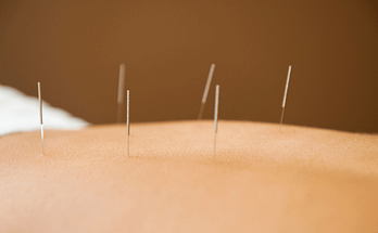 acupuncture back pain posture