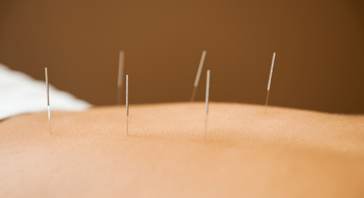acupuncture back pain posture