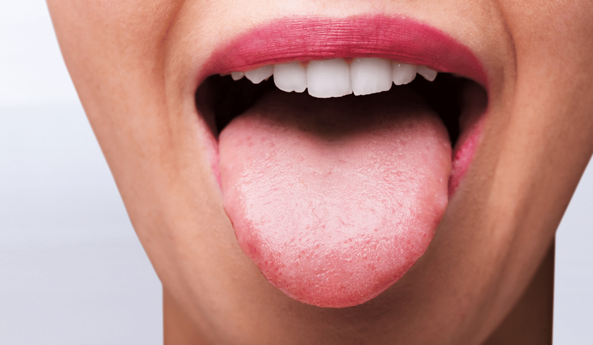 Proper Tongue Posture: Why Does It Matter?